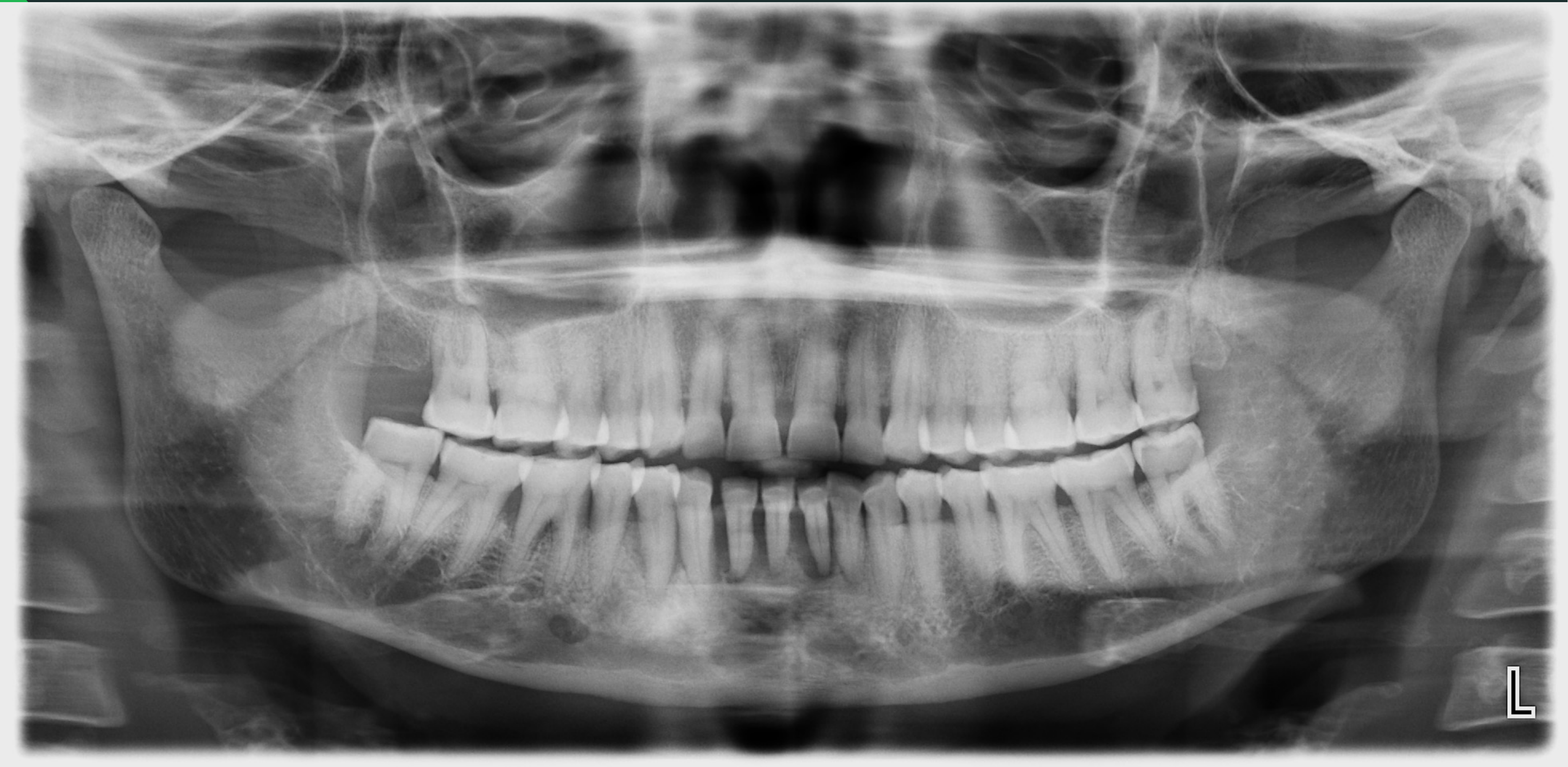 Periodontal Disease #