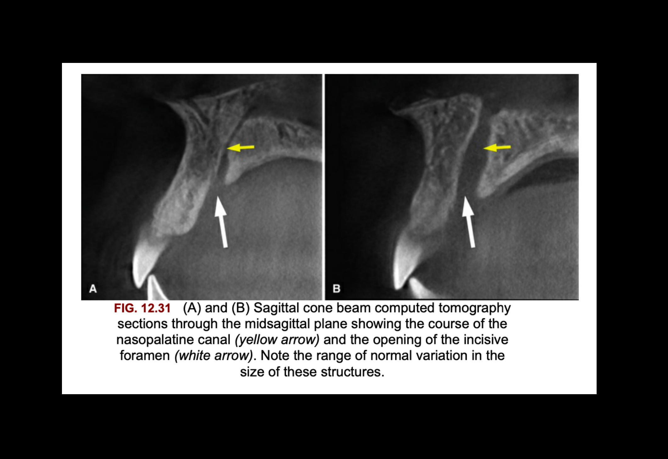 FIG. 12.31 (A) and (B) Sagittal cone beam computed tomography sections through the midsagittal plane showing the course of the nasopalatine canal (yellow arrow) and the opening of the incisive foramen (white arrow). Note the range of normal variation in the size of these structures.
