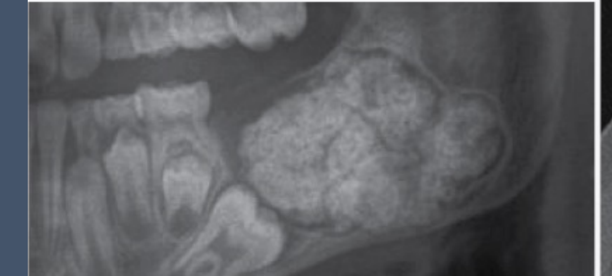 amorphous mix of calcified dental tissues