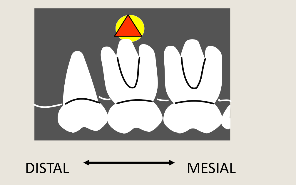 Right upper / maxillary periapical (paralleling technique)