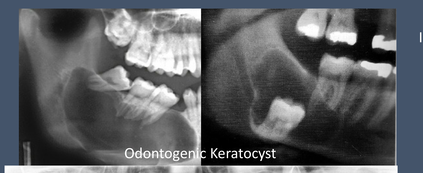 Odontogenic Keratocyst