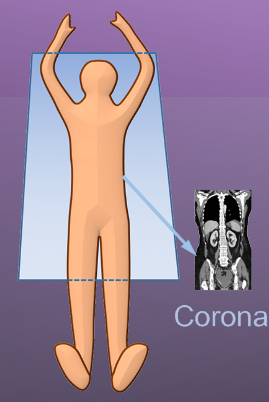 Coronal