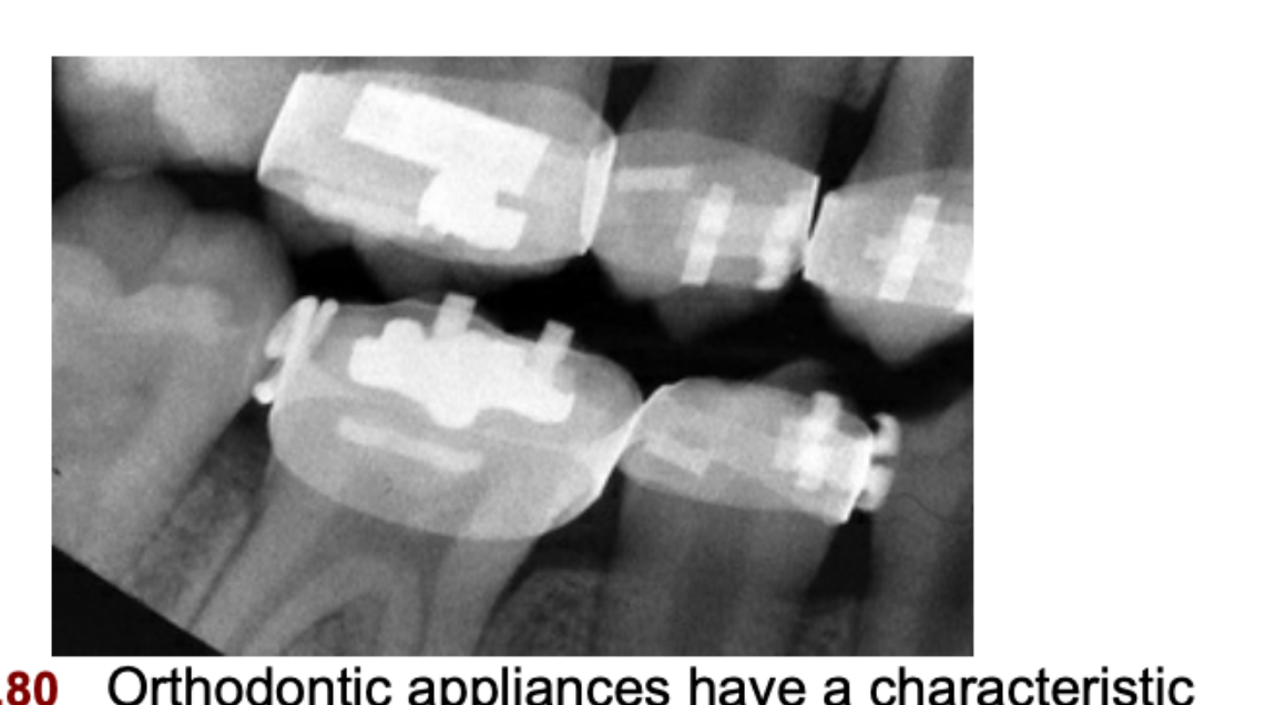 FIG. 12.80 Orthodontic appliances have a characteristic radiopaque appearance.