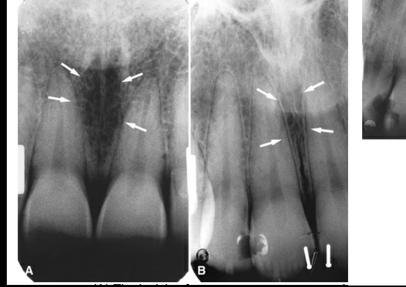 A and B. Radiographs showing the incisive canal.