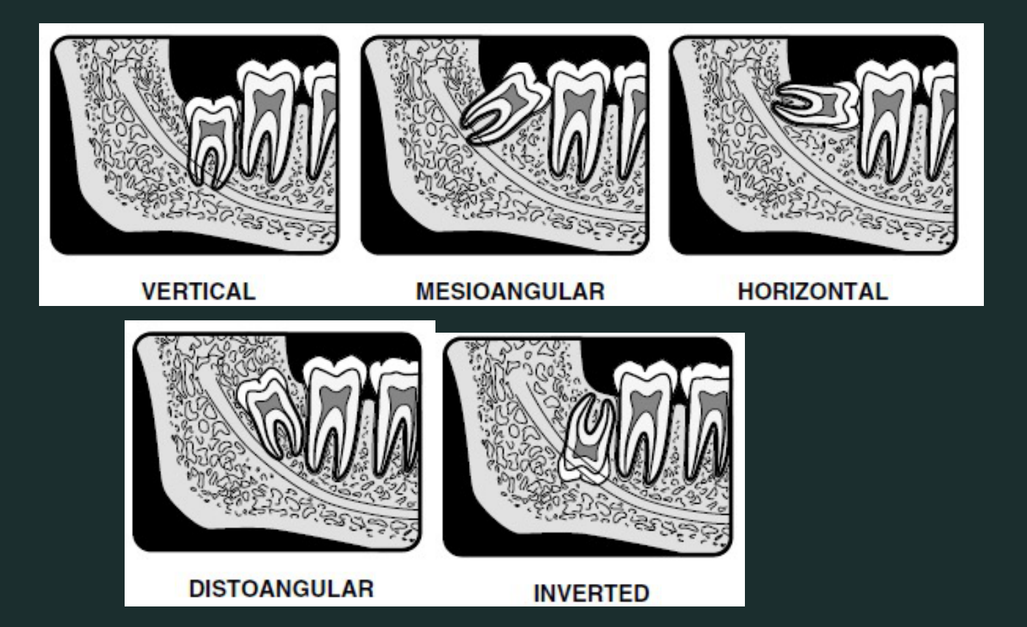 VERTICAL MESIOANGULAR HORIZONTAL DISTOANGULAR INVERTED