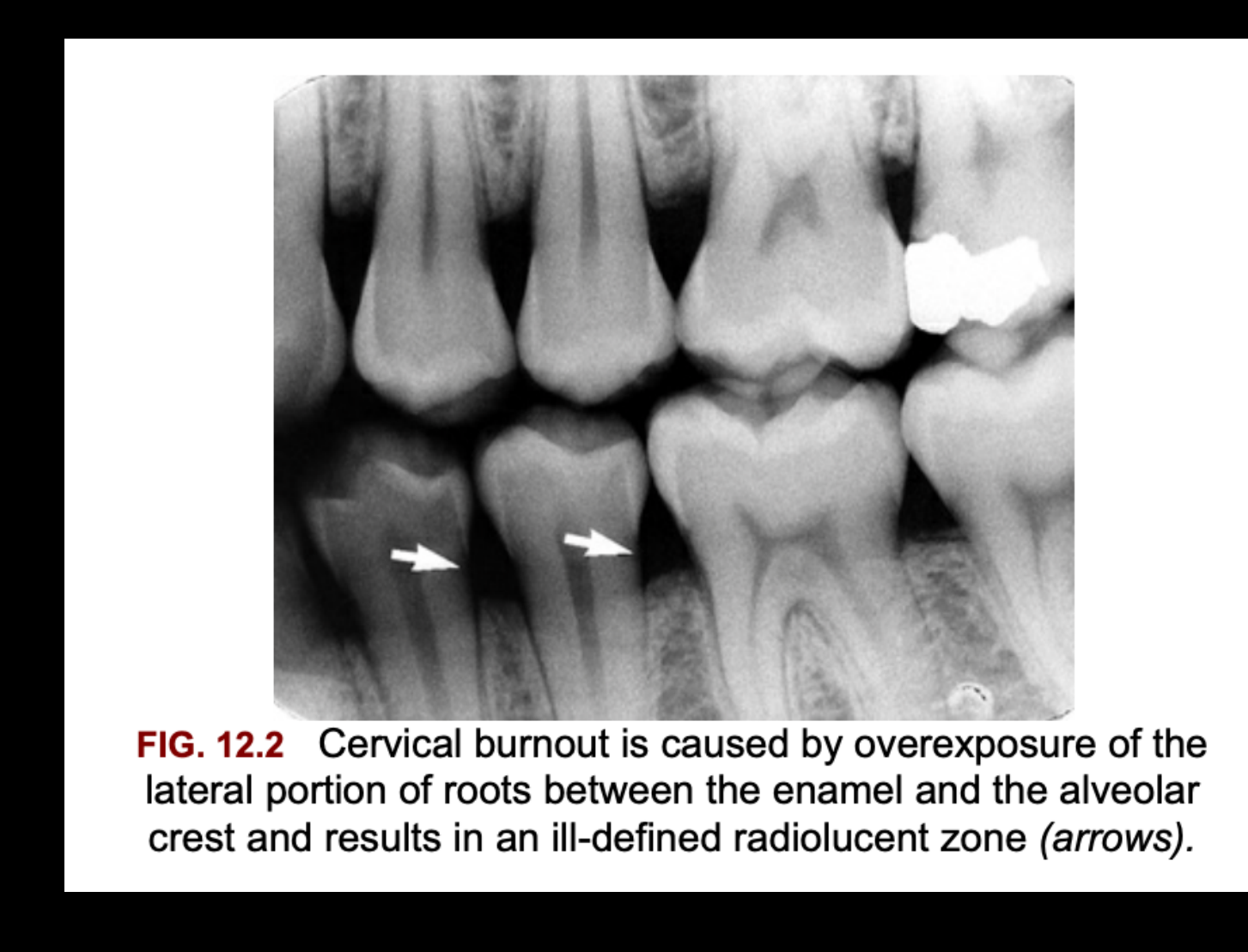 FIG. 12.2 Cervical burnout is caused by overexposure of the lateral portion of roots between the enamel and the alveolar crest and results in an ill-defined radiolucent zone (arrows).