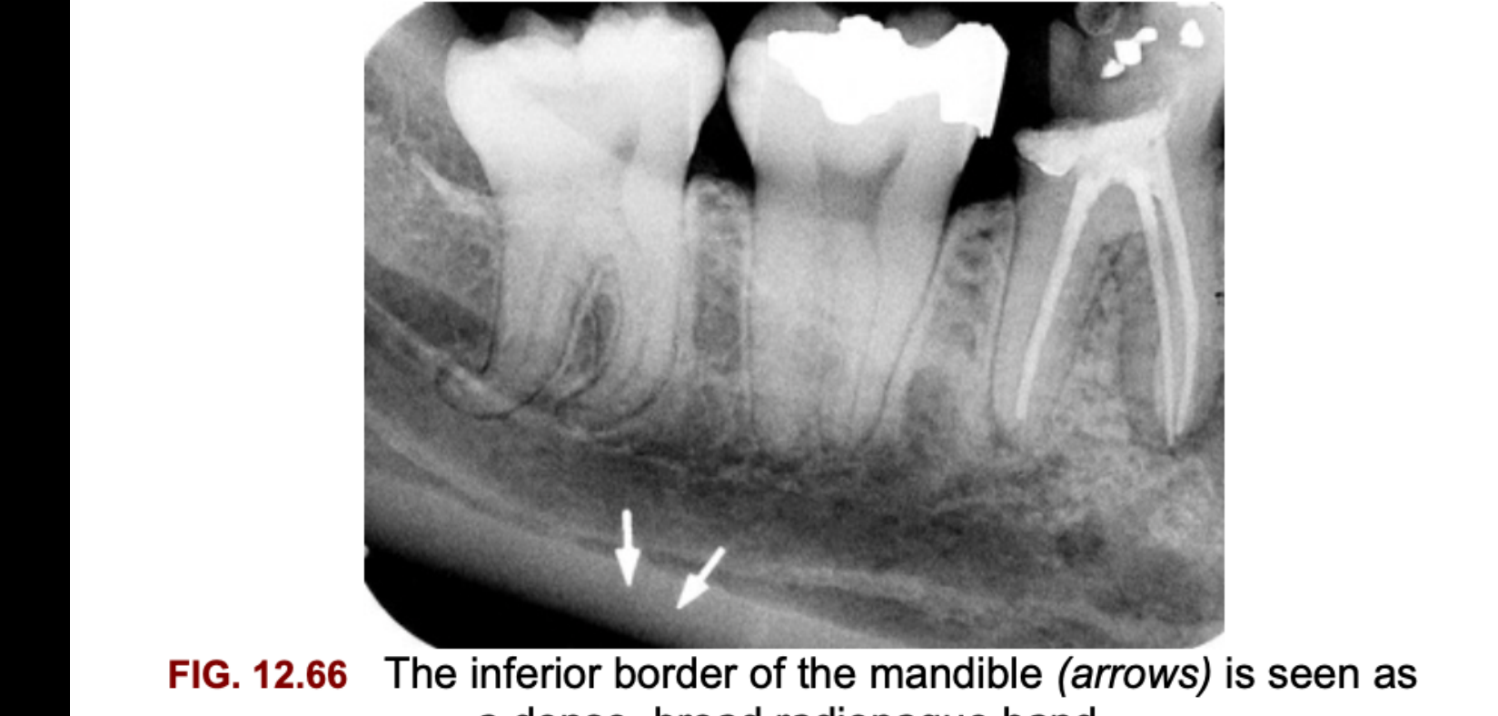 FIG. 12.66 The inferior border of the mandible (arrows) is seen as a dense, broad radiopaque band.