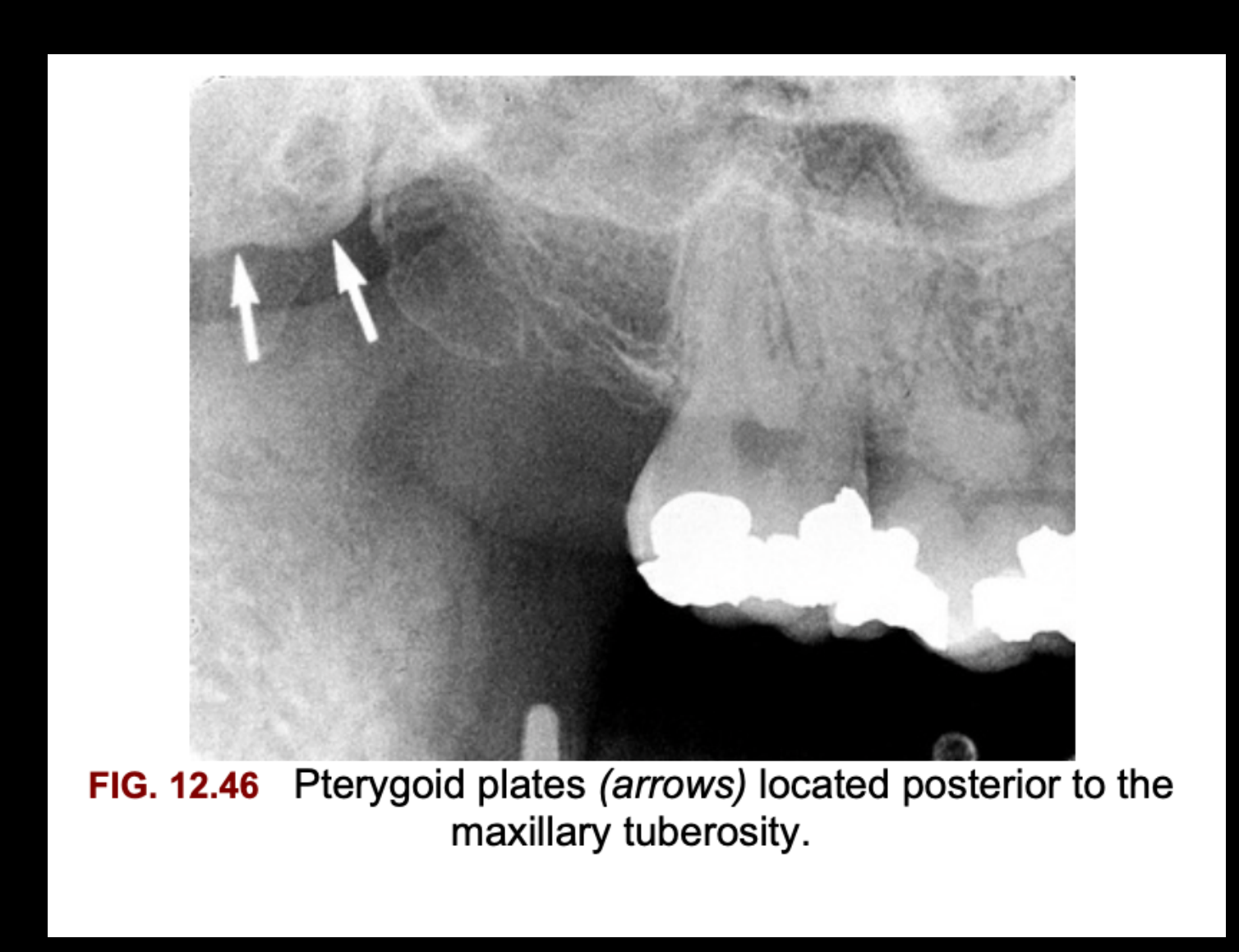 FIG. 12.46 Pterygoid plates (arrows) located posterior to the maxillary tuberosity.