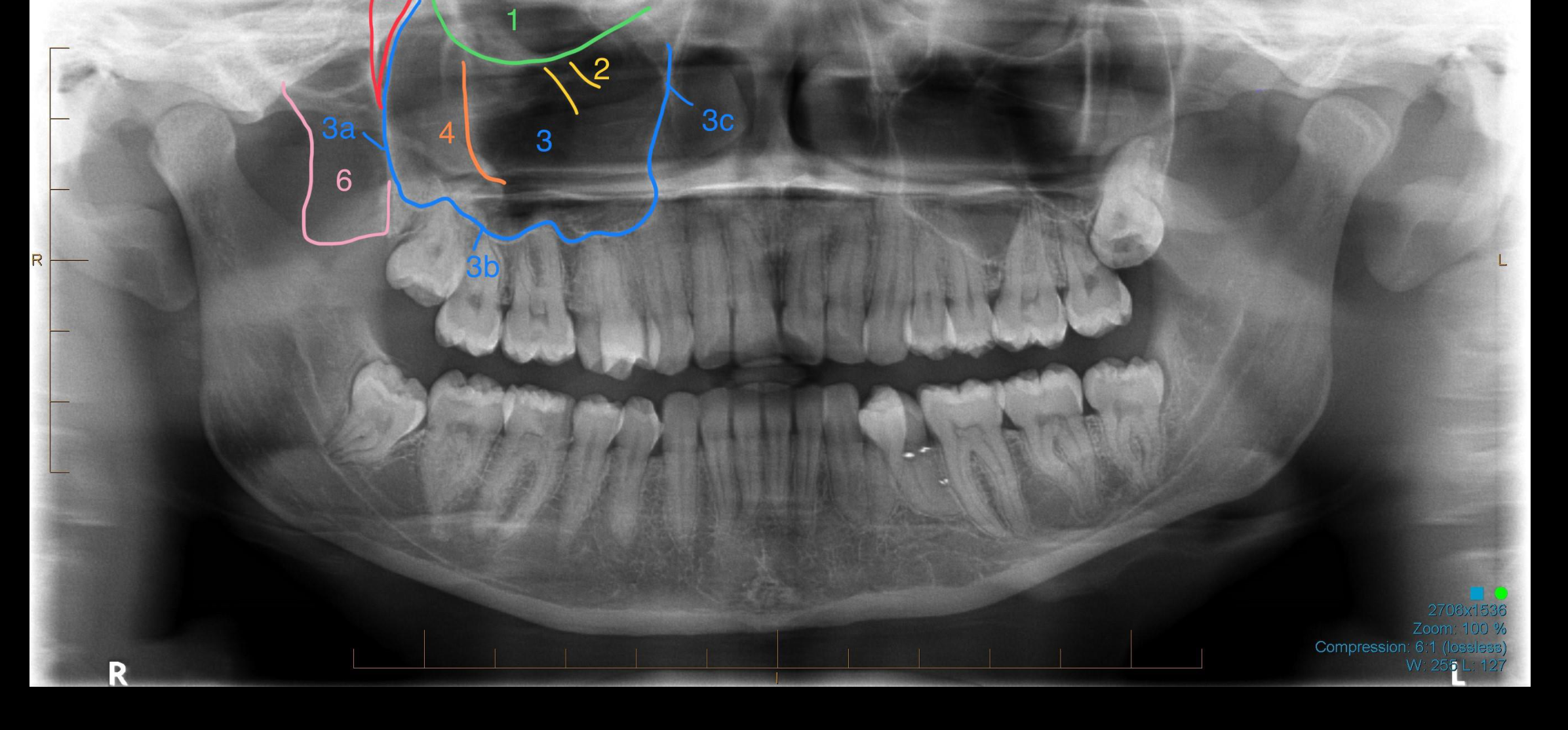 Case 5a – Midface Structures