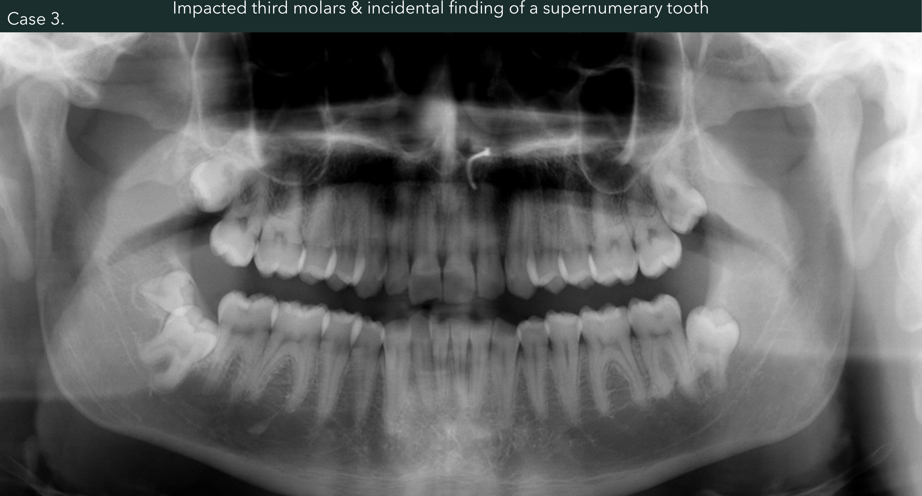 Case 3. Impacted third molars & incidental finding of a supernumerary tooth