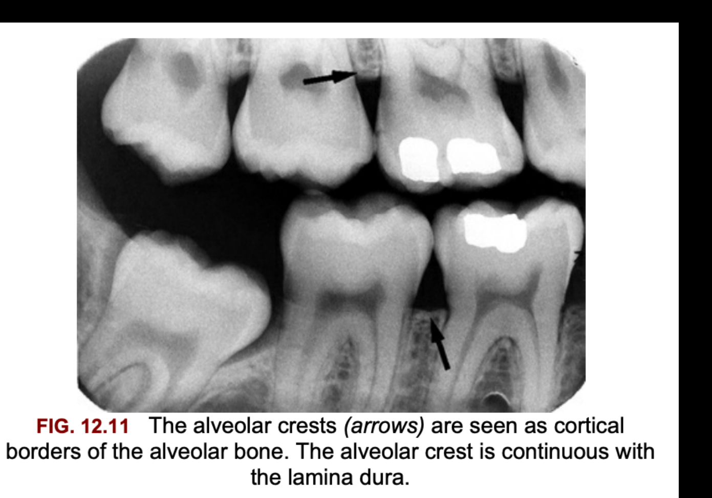 FIG. 12.11 The alveolar crests (arrows) are seen as cortical borders of the alveolar bone. The alveolar crest is continuous with the lamina dura.