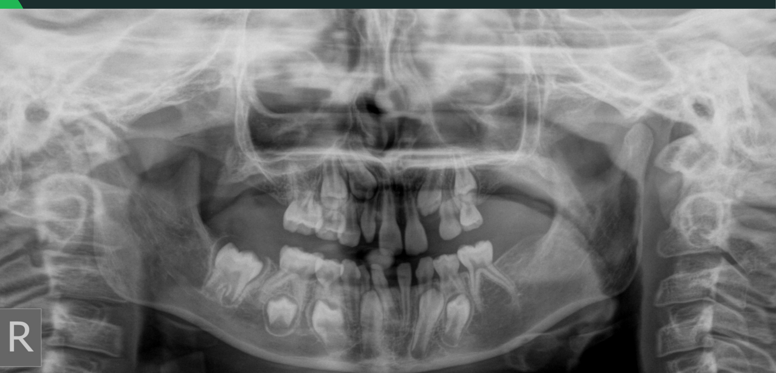 Mixed dentition #4 – Permanent Teeth Development and Position