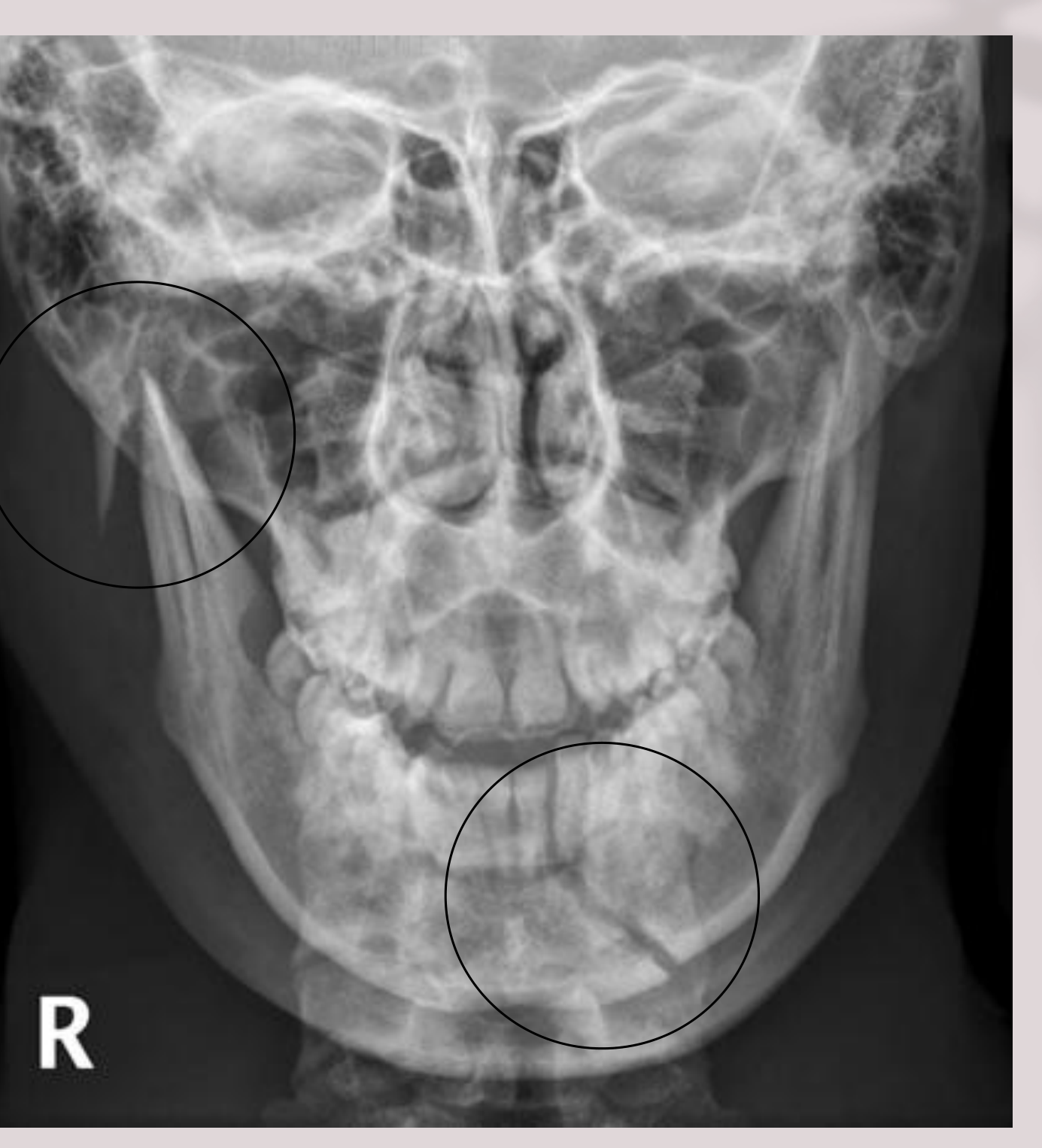 PA Jaw / MD