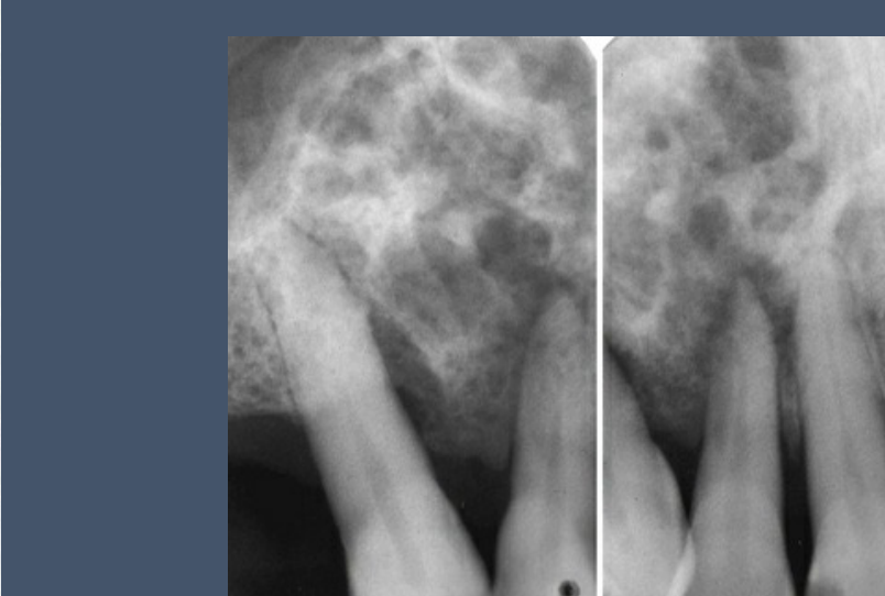 Recurrent Ameloblastoma