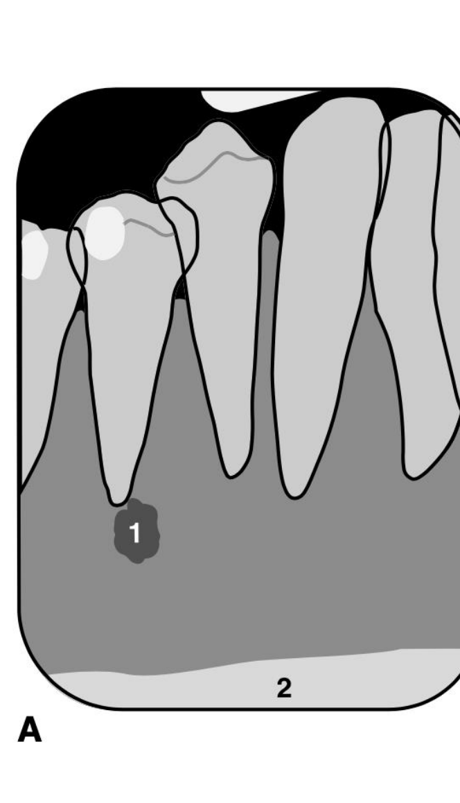 A. Diagram showing tooth roots and bone structure with labels 1 and 2.