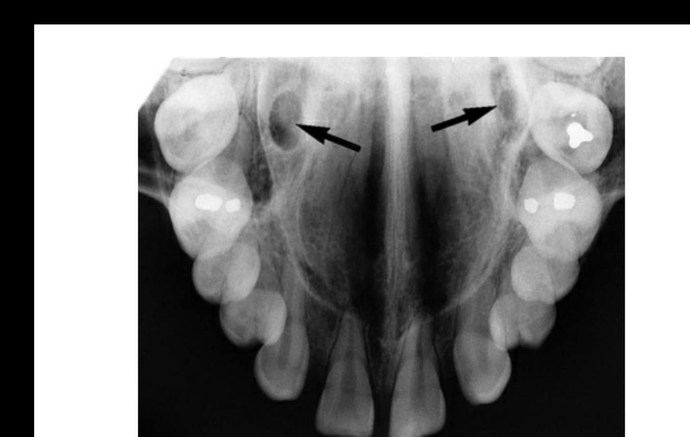 FIG. 12.35 The nasolacrimal canals are commonly seen as ovoid radiolucencies (arrows) on maxillary occlusal projections. They should not be confused with the greater palatine foramina, which are not apparent on maxillary occlusal projections.