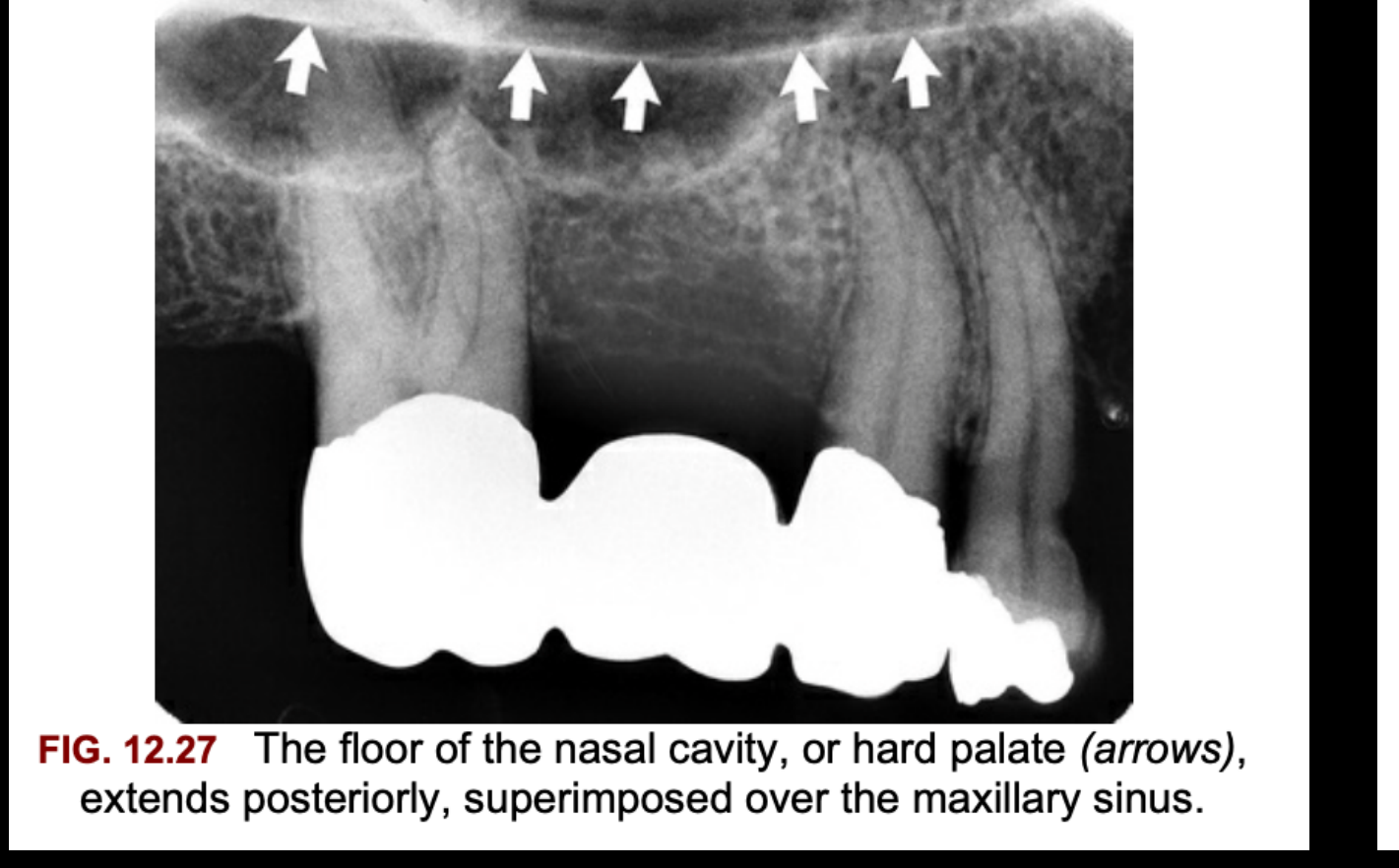 FIG. 12.27 The floor of the nasal cavity, or hard palate (arrows), extends posteriorly, superimposed over the maxillary sinus.