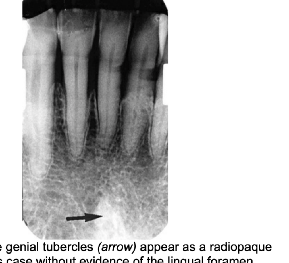 FIG. 12.50 The genial tubercles (arrow) appear as a radiopaque mass, in this case without evidence of the lingual foramen.
