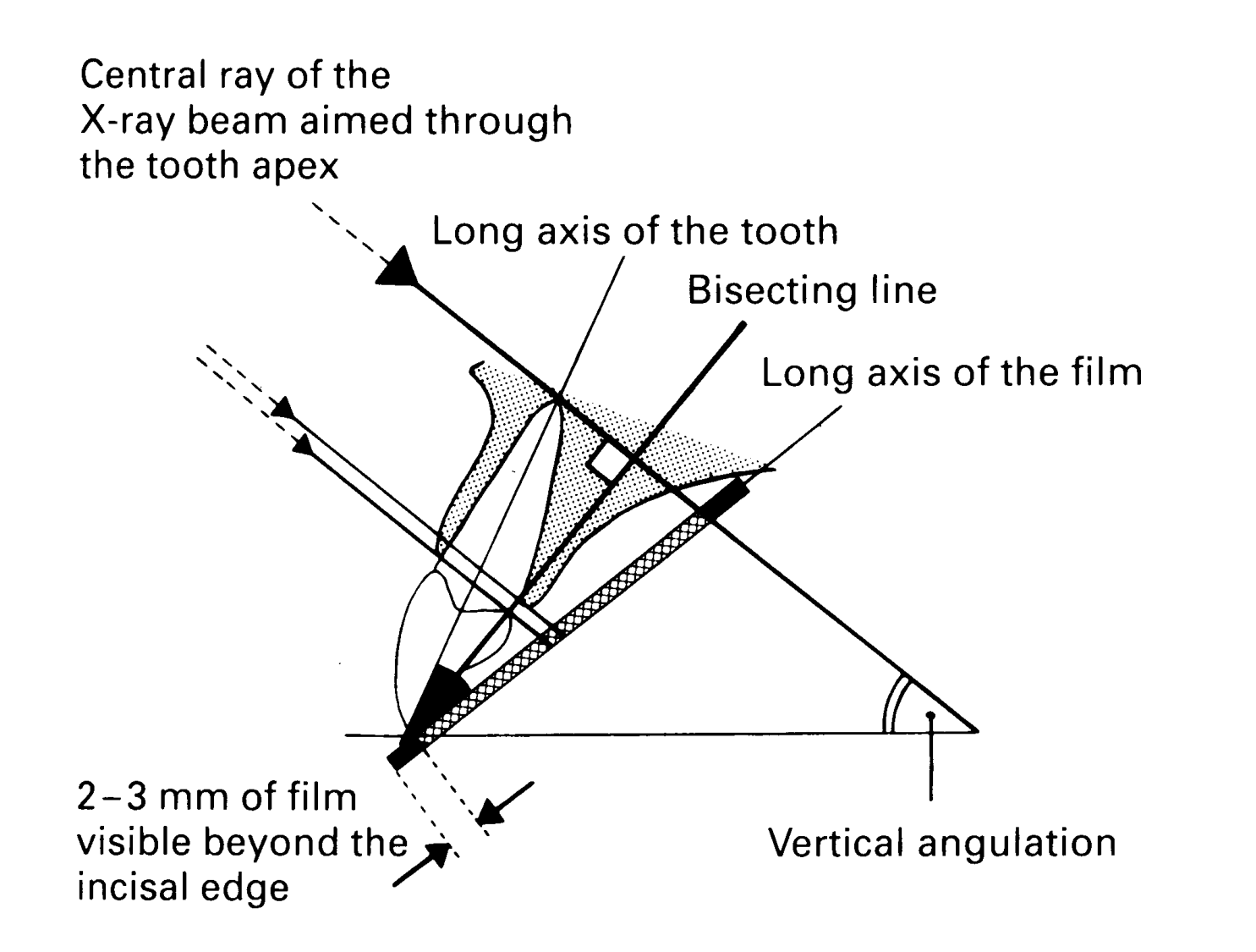 Principle of the Bisecting angle technique = Cieszynski's rule of isometry