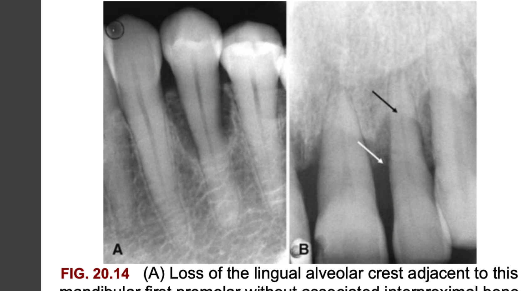FIG. 20.14 (A) Loss of the lingual alveolar crest adjacent to this mandibular first premolar without associated interproximal bone loss. (B) Loss of the buccal cortical bone adjacent to the maxillary central and lateral incisors. The black arrow indicates the level of the buccal alveolar crest, which demonstrates more profound loss relative to the lingual alveolar crest (white arrow).