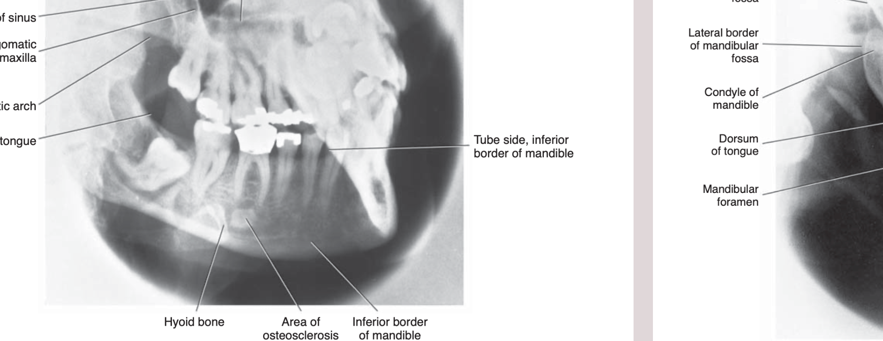 FIG. 12-7 Anatomic landmarks identified in the oblique lateral projection of the mandibular body.