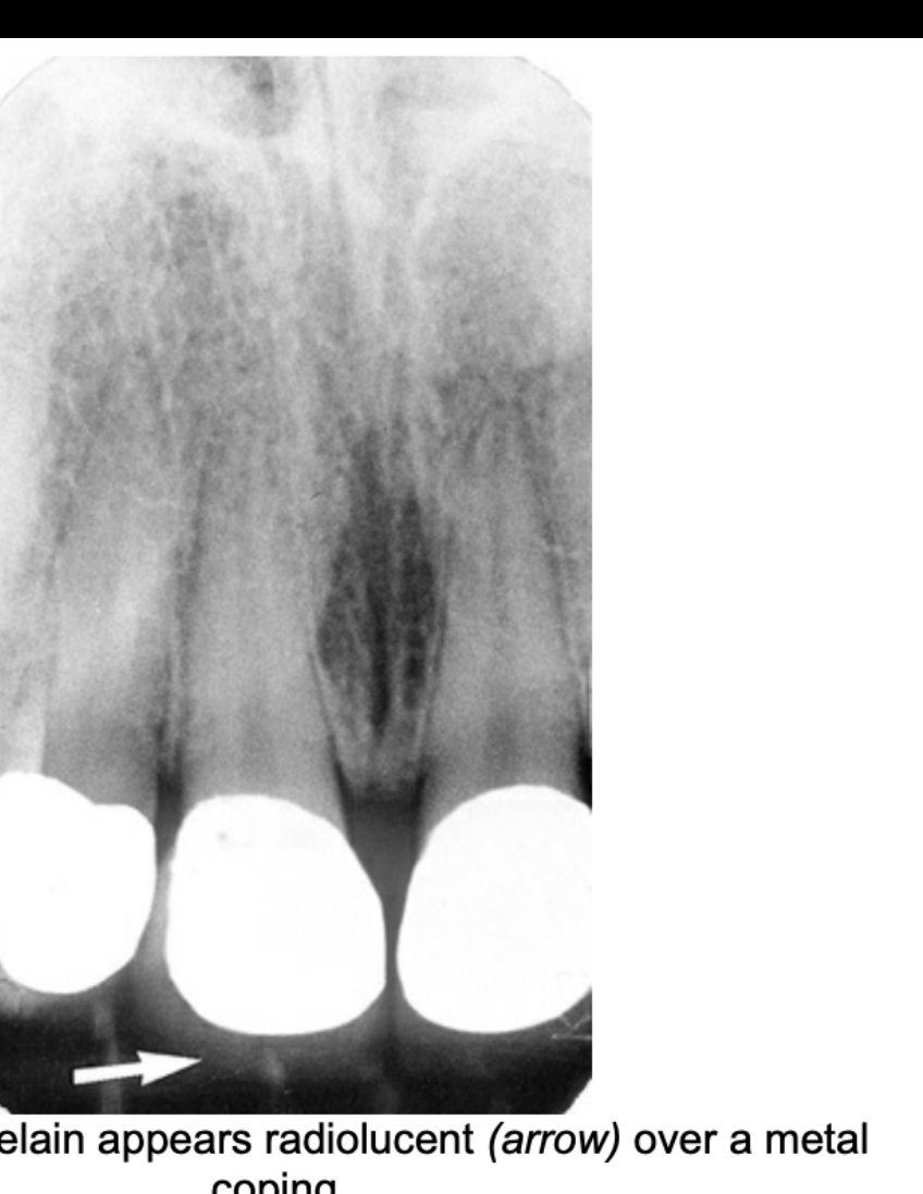 FIG. 12.79 Porcelain appears radiolucent (arrow) over a metal coping.