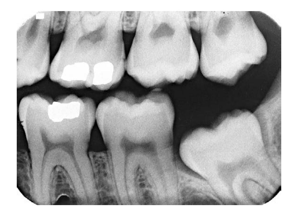 Left Posterior Bitewing (BW)