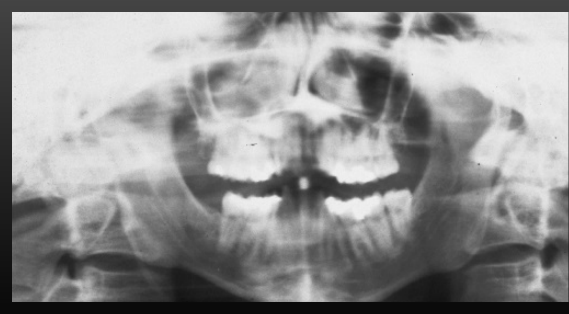 Teeth in front of focal trough