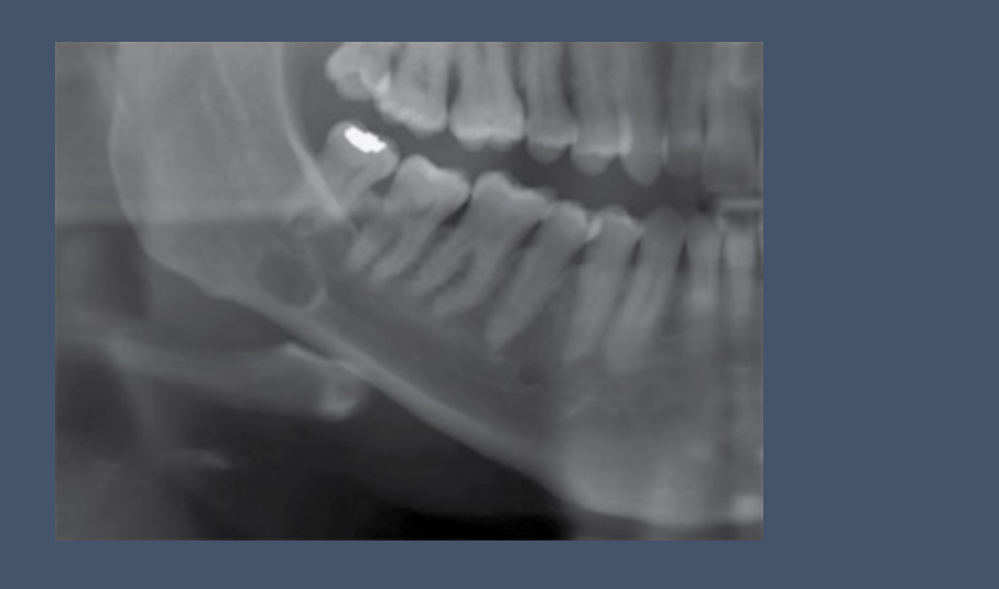 OPG: Well-defined lucency with heavily / thick corticated border