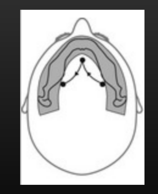 Arch (mandible ) shape