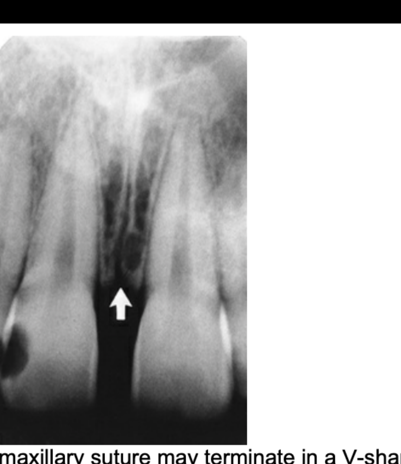 FIG. 12.20 The intermaxillary suture may terminate in a V-shaped widening (arrow) at the alveolar crest. This is a normal variation and should not be confused with alveolar bone loss associated with periodontal disease.