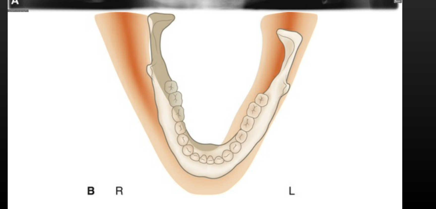 B