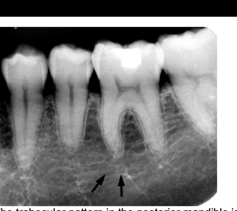 FIG. 12.17 The trabecular pattern in the posterior mandible is quite variable, generally showing large marrow spaces and sparse trabeculation, especially inferiorly (arrows).