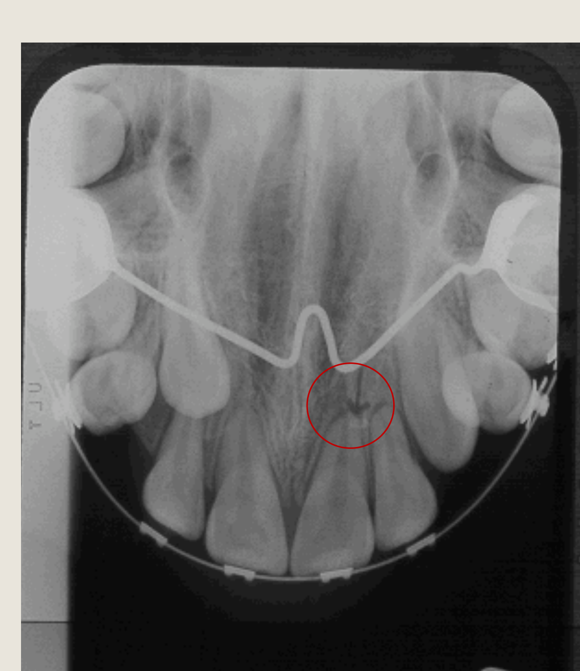 Vertical Tube Shift Technique using Occlusograph & Extra-oral Panoramic Radiograph