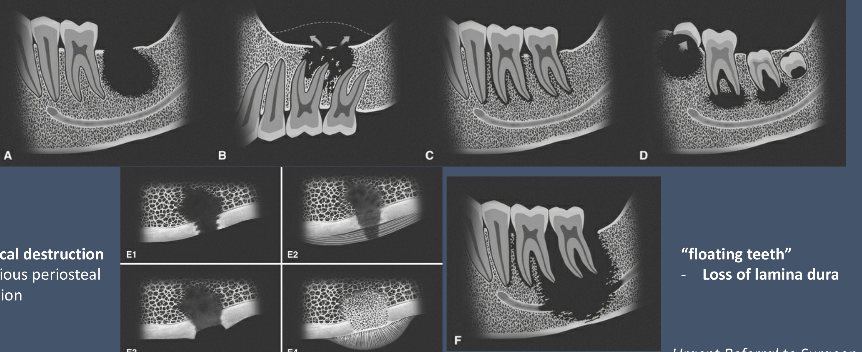 Malignancy: Ill-defined borders, fast-growing, destructive, invasive (invade through path of least resistance). Cortical destruction + various periosteal reaction. 'floating teeth' - Loss of lamina dura. Urgent Referral to Surgeon.