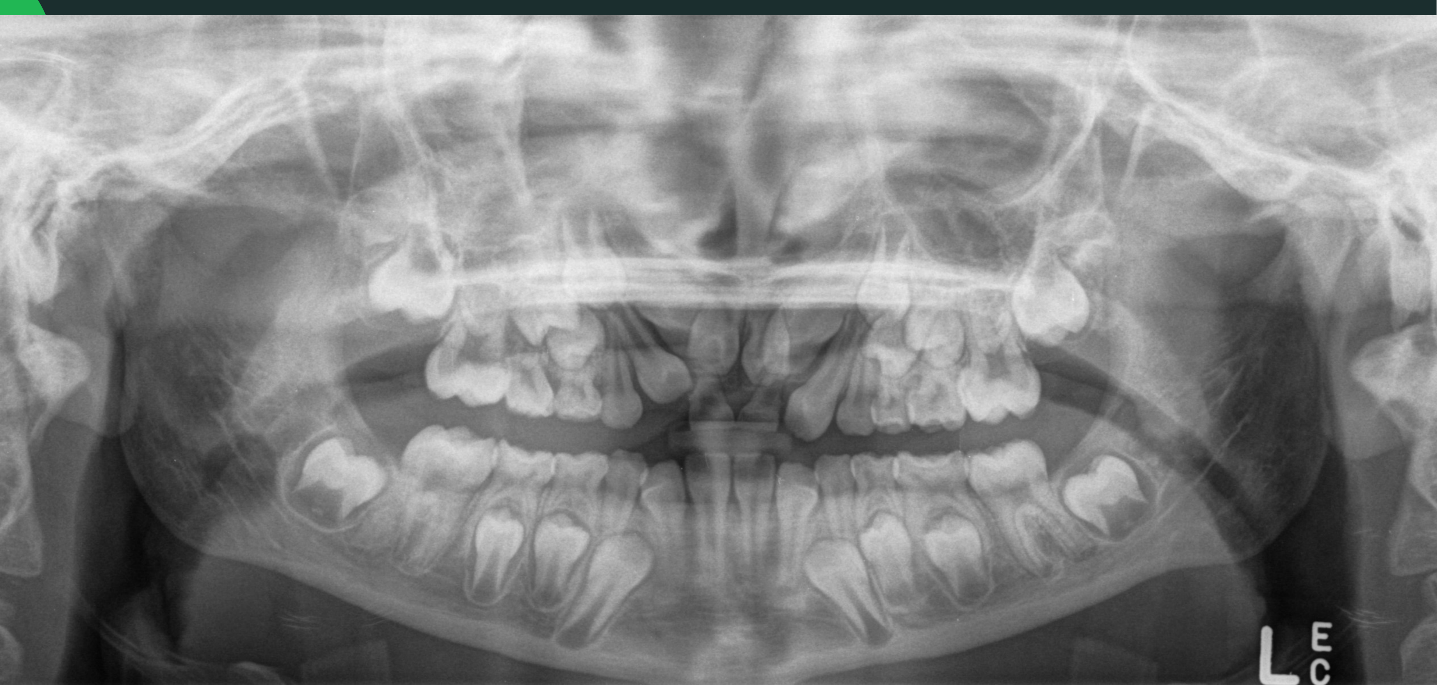 Mixed dentition #3 - Permanent Teeth Development and Position