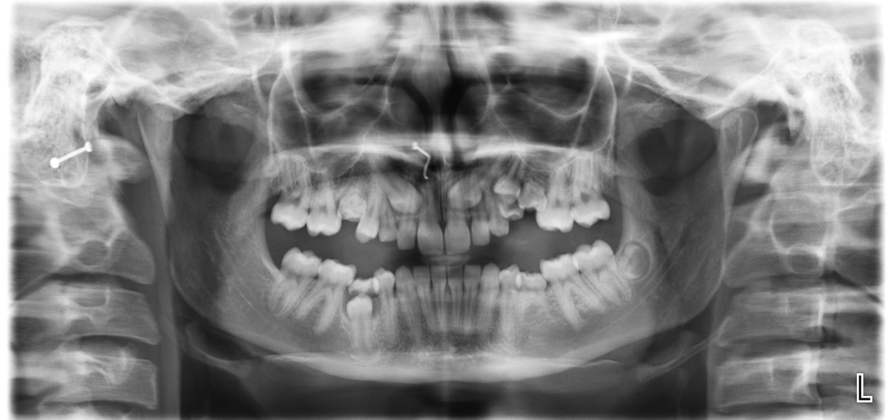 Mixed dentition #5 – Submerged Deciduous Molars + Permanent Teeth Development and Position