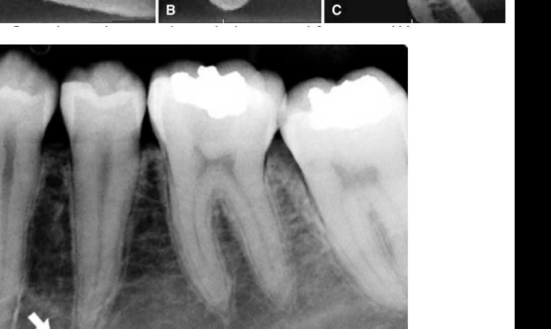 FIG. 12.56 The mental foramen (arrow) (over the apex of the second premolar) may simulate periapical disease. However, continuity of the lamina dura around the apex indicates the absence of periapical abnormality.