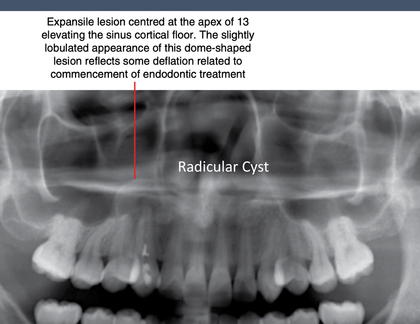 Expansile lesion centred at the apex of 13 elevating the sinus cortical floor. The slightly lobulated appearance of this dome-shaped lesion reflects some deflation related to commencement of endodontic treatment