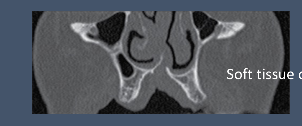 Soft tissue coverage