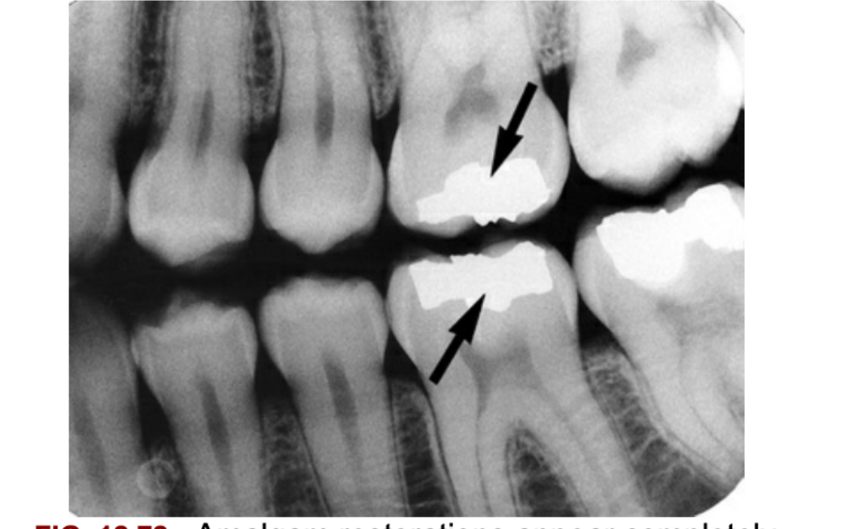 FIG. 12.72 Amalgam restorations appear completely radiopaque (arrows).