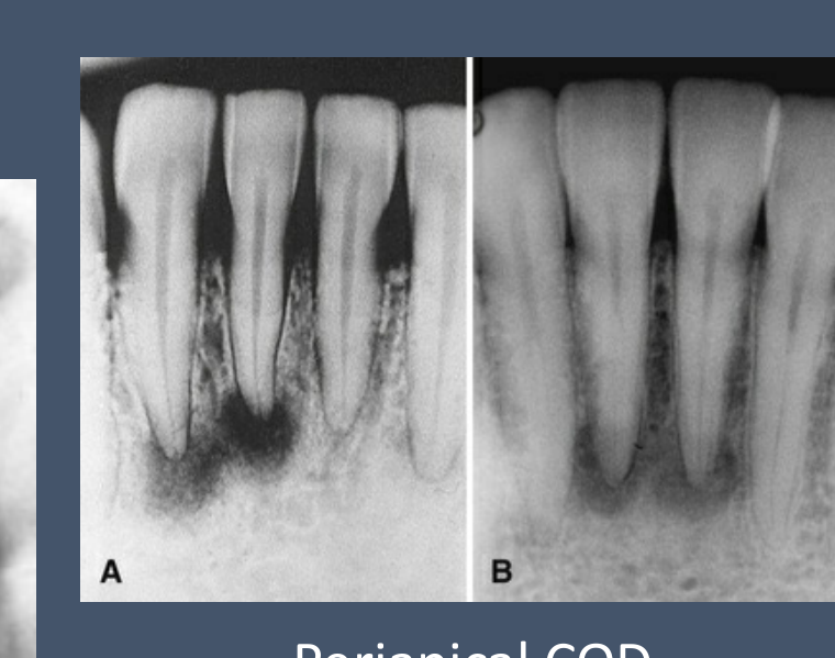 Periapical COD