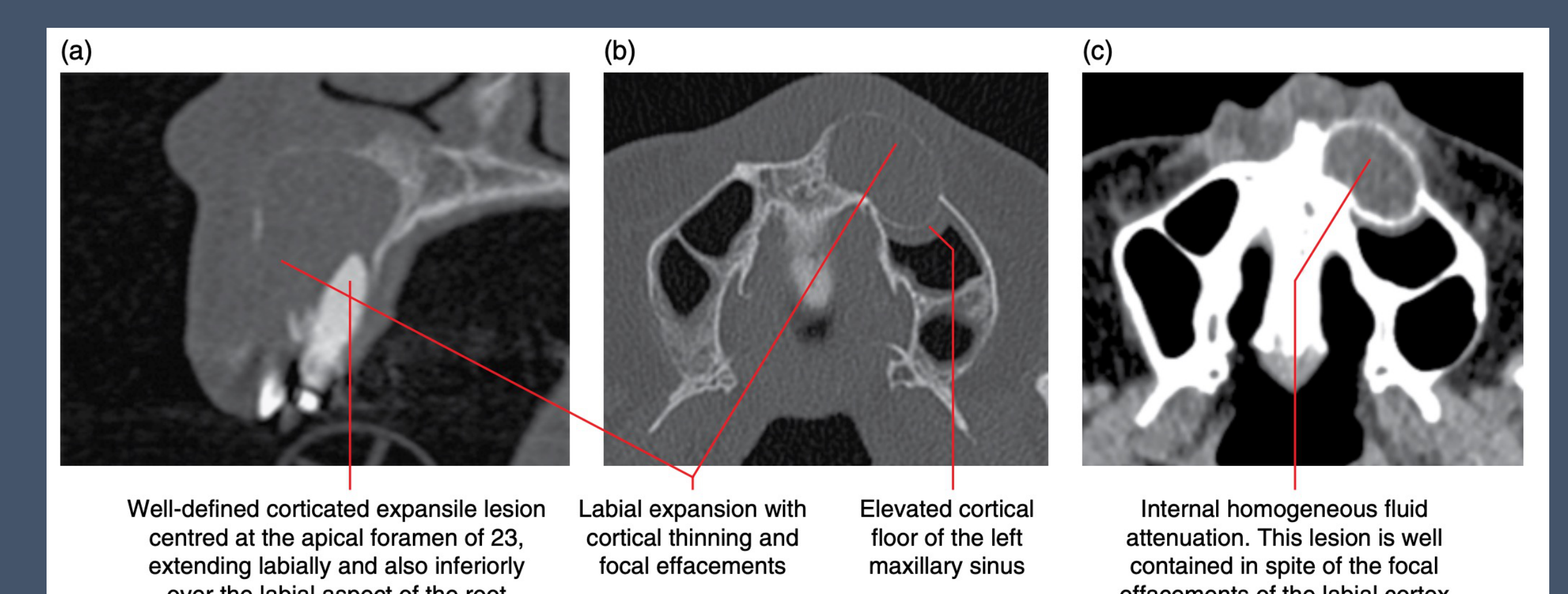 Radicular Cyst on MSCT / MDCT
