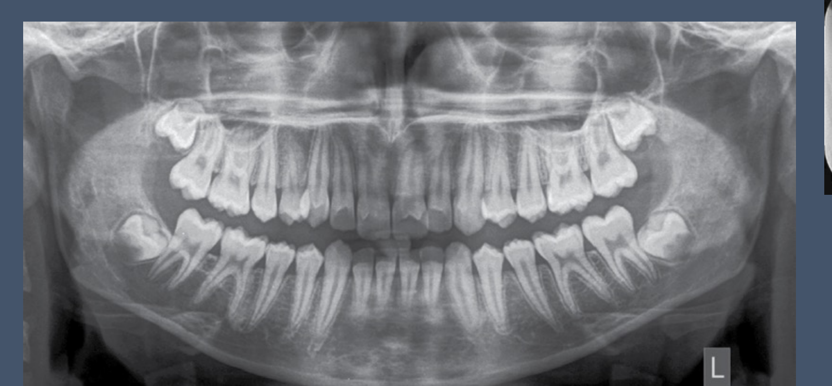 Simple Bone Cyst