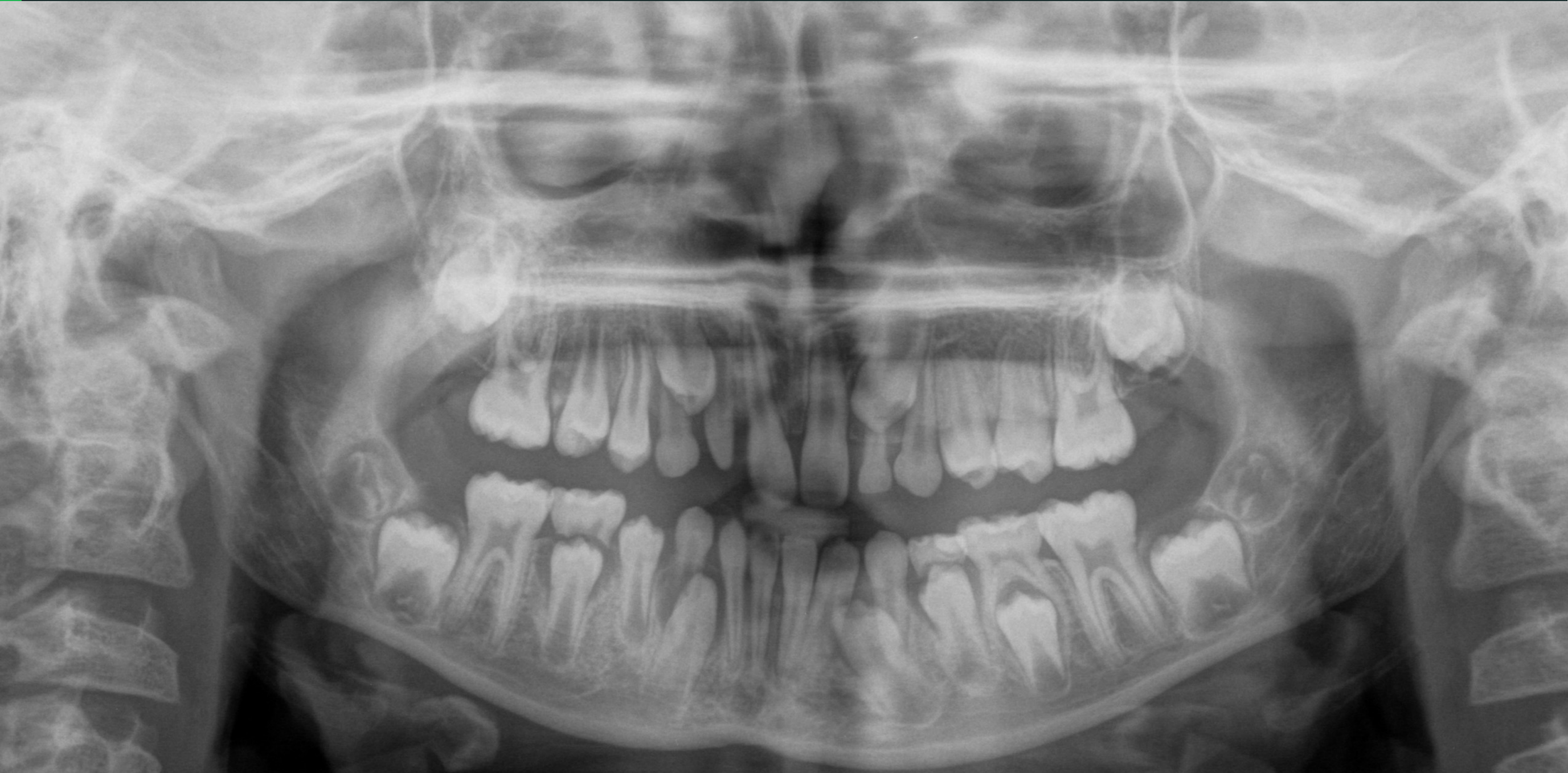 Mixed dentition #2 – Permanent Teeth Development and Position
