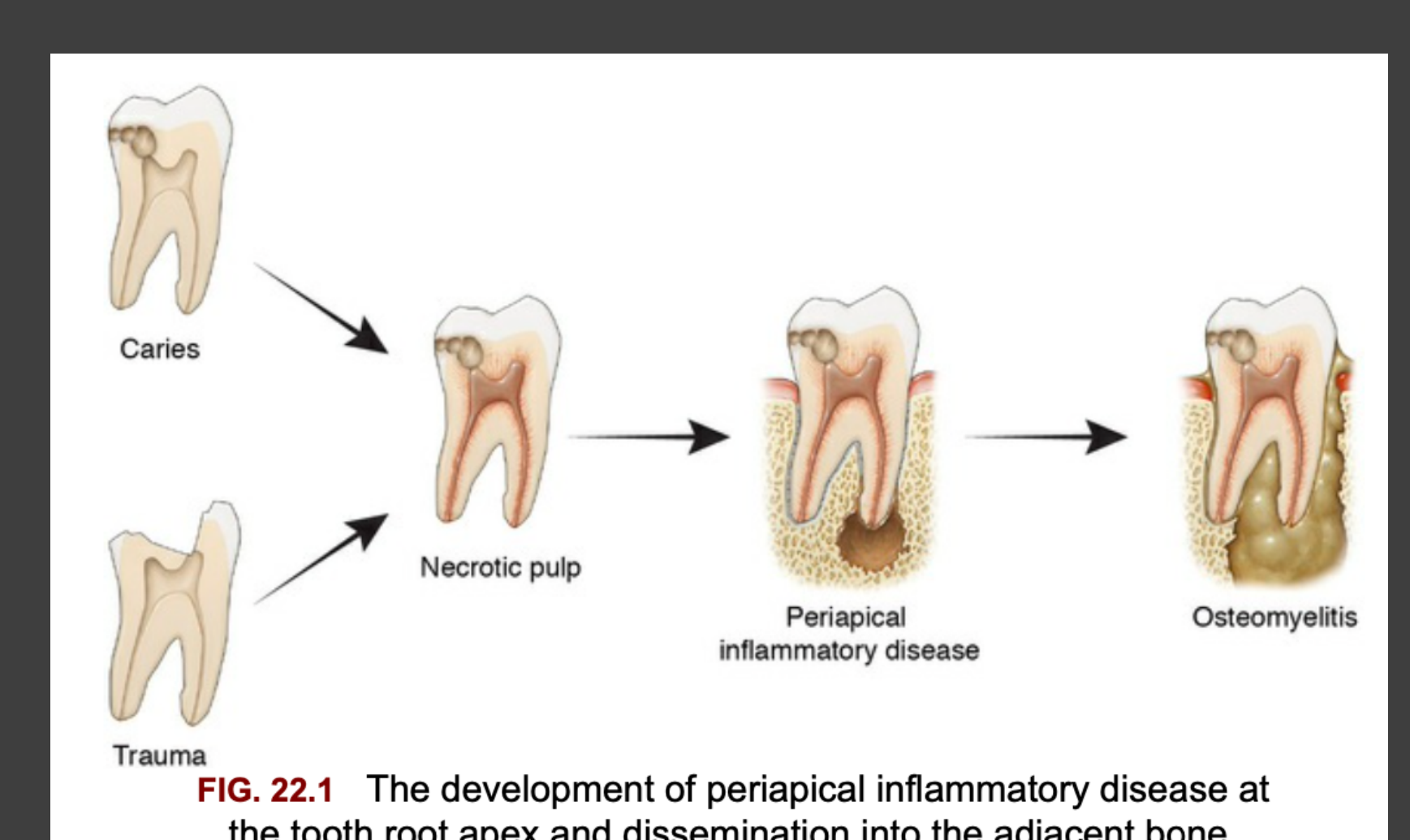 FIG. 22.1 The development of periapical inflammatory disease at the tooth root apex and dissemination into the adjacent bone.