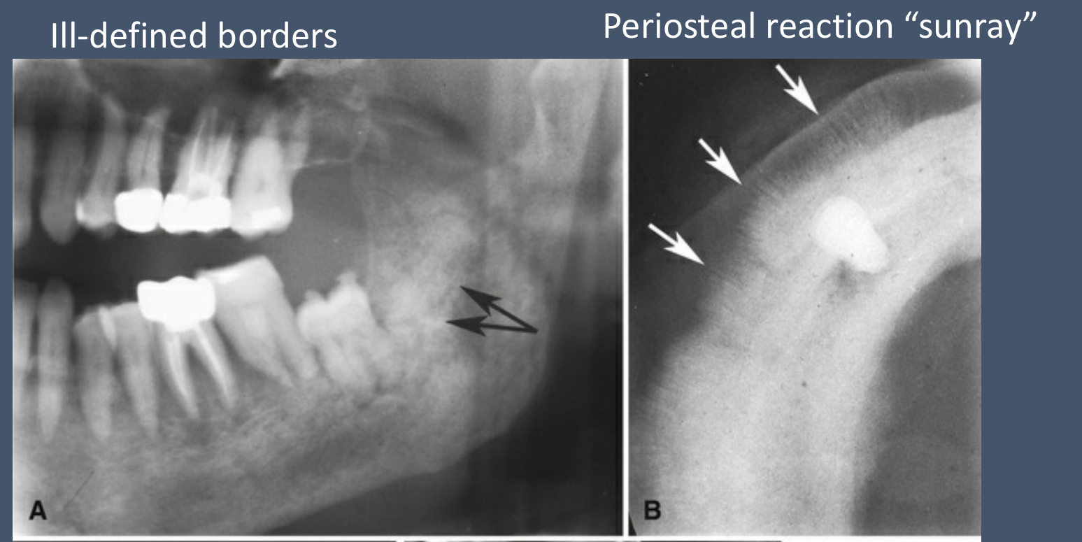 Ill-defined borders; Periosteal reaction 'sunray'; Loss of lamina dura
