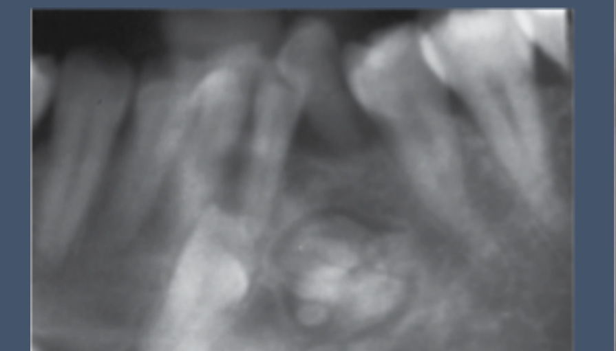 Multiple tooth-like opacities