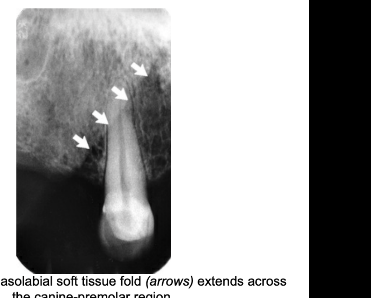 FIG. 12.45 The nasolabial soft tissue fold (arrows) extends across the canine-premolar region.