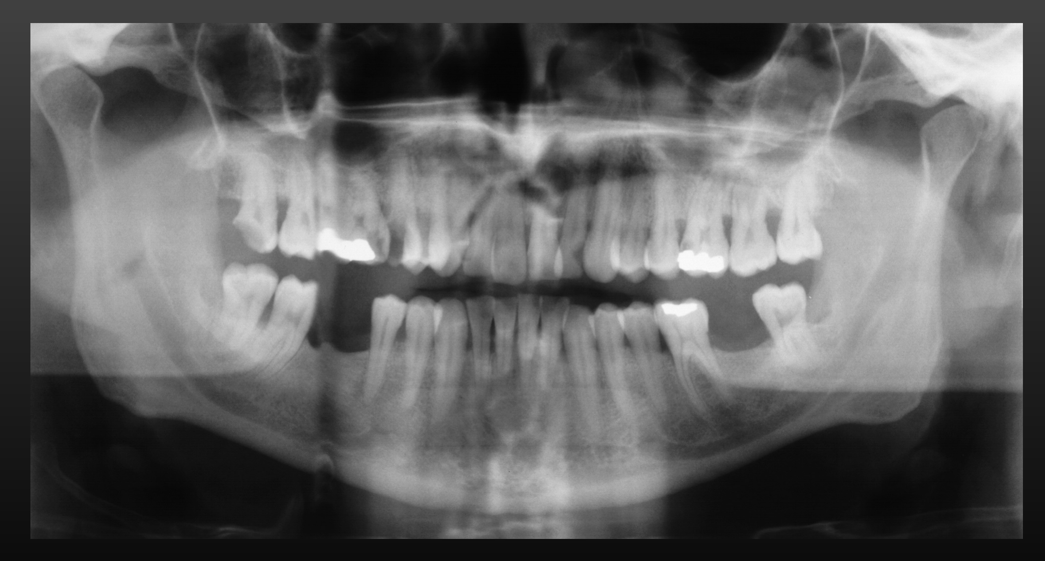 Patient moved horizontally; deletion & doubling